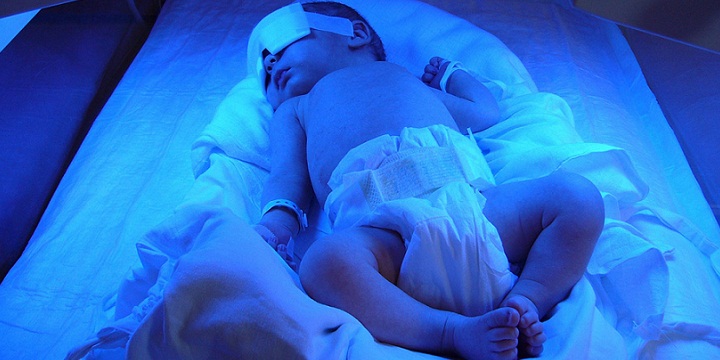zar - ۸۰ درصد نوزادان نارس زردی می گیرند