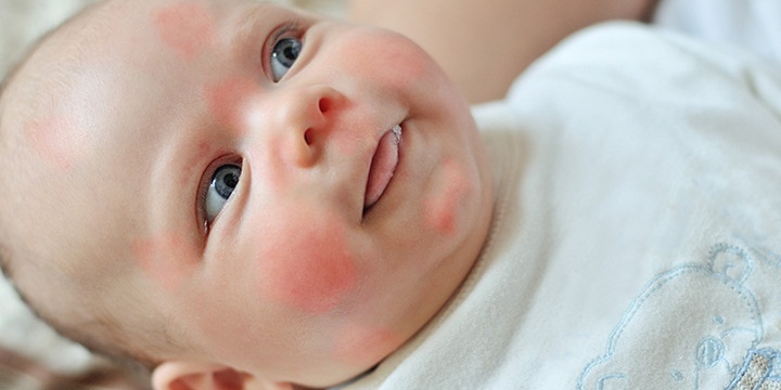 Milk allergy - حساسیت شایع نوزاد به شیر