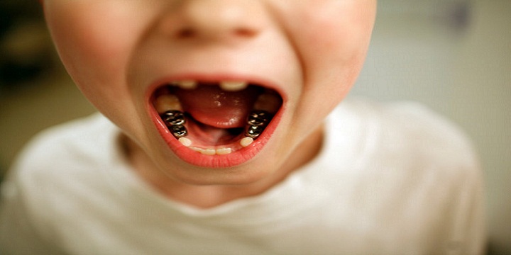 misconception teeth master768 - دندان نوزاد، علت رنگی شدن