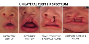 UnilateralCleftLipSpectrum 300x150 - لب شکری شدن بچه، تشخیص در سونوگرافی