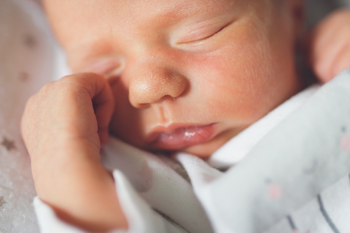 میلیا در نوزادان چیست و چگونه درمان می شود؟