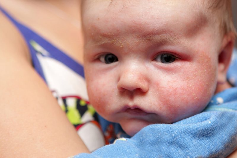 آلرژی نوزاد در 4 مرحله و اقدامات احتیاطی